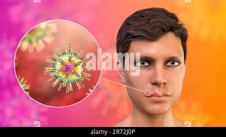 Lippenherpes an der Lippe eines Mannes und Nahaufnahme von Herpes simplex-Viren, Computerdarstellung. Lippenherpes sind schmerzhafte, mit Flüssigkeit gefüllte Blasen verursacht Stockfoto