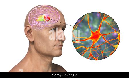 Dorsales Striatum hervorgehoben im menschlichen Gehirn und Nahaufnahme seiner Neuronen, Computerdarstellung. Es ist ein Kern in den Basalganglien, eine Komponente Stockfoto