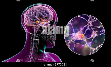 Amygdala im Gehirn und Nahaufnahme von Amygdala-Neuronen, Computerdarstellung. Zwei mandelförmige Kerne in Temporallappen, Teil o Stockfoto