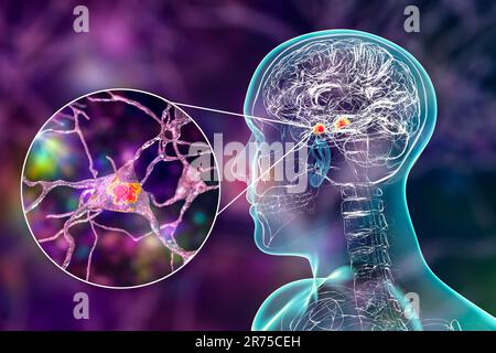 Amygdala im Gehirn und Nahaufnahme von Amygdala-Neuronen, Computerdarstellung. Zwei mandelförmige Kerne in Temporallappen, Teil o Stockfoto