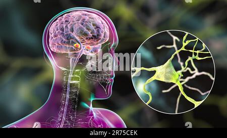 Amygdala im Gehirn und Nahaufnahme von Amygdala-Neuronen, Computerdarstellung. Zwei mandelförmige Kerne in Temporallappen, Teil o Stockfoto