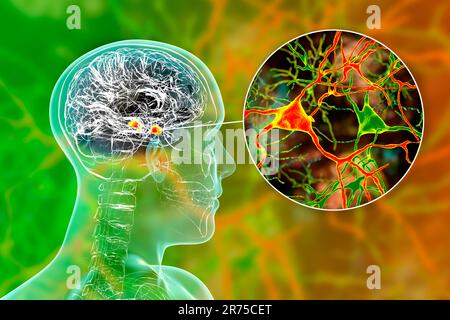 Amygdala im Gehirn und Nahaufnahme von Amygdala-Neuronen, Computerdarstellung. Zwei mandelförmige Kerne in Temporallappen, Teil o Stockfoto