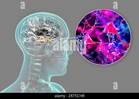 Amygdala im Gehirn und Nahaufnahme von Amygdala-Neuronen, Computerdarstellung. Zwei mandelförmige Kerne in Temporallappen, Teil o Stockfoto