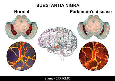Substantia nigra bei Morbus Parkinson. Computerdarstellung einer degenerierten Substantia nigra bei Morbus Parkinson. Die Substantia nigra pla Stockfoto