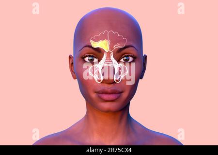 Nasennebenhöhlenentzündung oder Sinusitis, Computerdarstellung. Die Nebenhöhlen sind membranausgekleidete, luftgefüllte Räume in den Gesichtsknochen. Die Stirnhöhlen A. Stockfoto