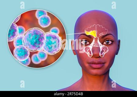 Moraxella-catarrhalis-Bakterien als Ursache einer Sinusitis. Computerdarstellung der Stirnhöhlenentzündung und Nahaufnahme von Moraxella Bac Stockfoto
