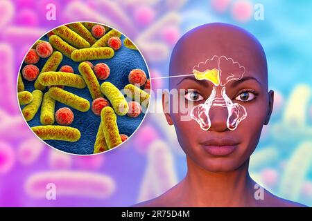 Sinusitis, Entzündung der Nasennebenhöhlen. Computerdarstellung einer eitrigen Entzündung der Stirn- und Kieferhöhlen bei einer Frau und einem Klo Stockfoto