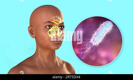 Pseudomonas aeruginosa-Bakterien als Ursache einer Sinusitis. Computerdarstellung einer eitrigen Entzündung der Stirn-, Siebbein- und Kieferhöhle Stockfoto