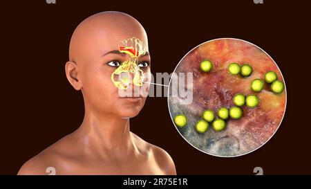 Streptococcus pyogenes-Bakterien als Ursache einer Sinusitis. Computerdarstellung mit Entzündung der Stirn-, Siebbein- und Kieferhöhlen und klo Stockfoto