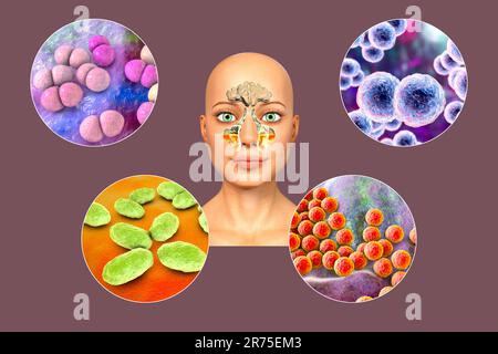 Anatomie der Rhinosinusitis und Sinusitis-verursachender Bakterien. Streptococcus pneumoniae, Moraxella catarrhalis, Haemophilus influenzae und Staphylococc Stockfoto