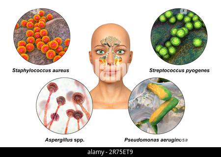 Anatomie der Rhinosinusitis und Sinusitis-verursachender Mikroorganismen. Streptococcus pneumoniae, Streptococcus mutans, Aspergillus fumigatus und Pseudomo Stockfoto