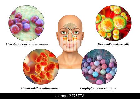 Anatomie der Rhinosinusitis und Sinusitis-verursachender Bakterien. Streptococcus pneumoniae, Moraxella catarrhalis, Haemophilus influenzae und Staphylococc Stockfoto