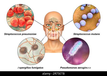 Anatomie der Rhinosinusitis und Sinusitis-verursachender Mikroorganismen. Streptococcus pneumoniae, Streptococcus mutans, Aspergillus fumigatus und Pseudomo Stockfoto