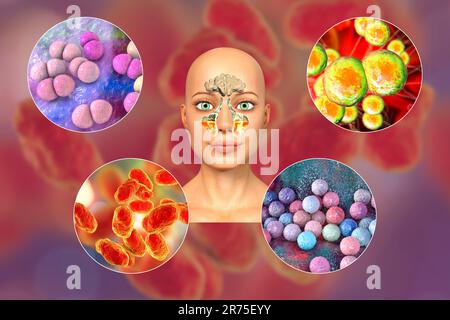 Anatomie der Rhinosinusitis und Sinusitis-verursachender Bakterien. Streptococcus pneumoniae, Moraxella catarrhalis, Haemophilus influenzae und Staphylococc Stockfoto