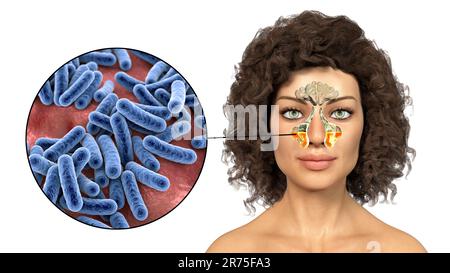 Sinusitis, Entzündung der Nasennebenhöhlen. Computerdarstellung einer eitrigen Entzündung der Kieferhöhlen bei einer Frau und Nahaufnahme o Stockfoto