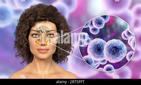 Moraxella-catarrhalis-Bakterien als Ursache einer Sinusitis. Computerdarstellung der Kieferhöhlenentzündung und Nahaufnahme von Moraxella Stockfoto