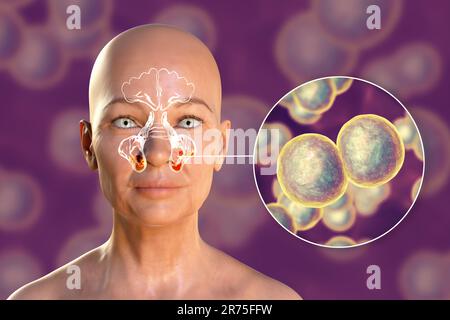Moraxella-catarrhalis-Bakterien als Ursache einer Sinusitis. Computerdarstellung der Kieferhöhlenentzündung und Nahaufnahme von Moraxella Stockfoto