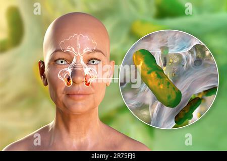 Pseudomonas aeruginosa-Bakterien als Ursache einer Sinusitis. Computerdarstellung der eitrigen Entzündung der Kieferhöhlen und Nahaufnahme Stockfoto