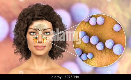 Streptococcus mutans-Bakterien als Ursache einer Sinusitis. Computerdarstellung der Kieferhöhlenentzündung und Nahaufnahme von Streptokokken Stockfoto