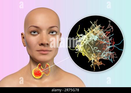 Schilddrüsenkrebs mit Nahaufnahme von Krebszellen, Computerdarstellung. Stockfoto