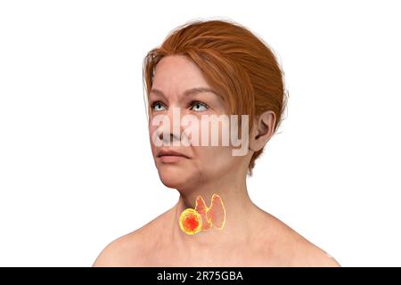 Schilddrüse Tumor, Computer Bild. Stockfoto