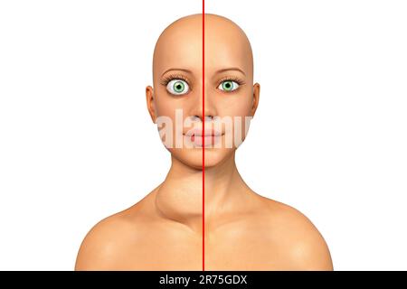 Thyreotoxische Struma (Struma), Illustration. Struma (geschwollener Hals) bei einer Patientin mit überaktiver Schilddrüse (links) im Vergleich Stockfoto