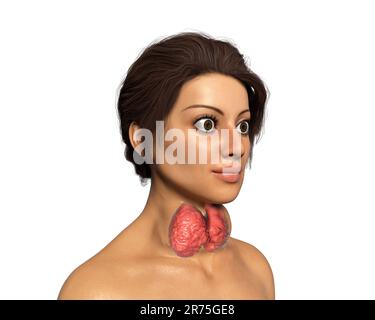 Thyreotoxische Struma (Struma), Illustration. Struma (geschwollener Hals) bei einer Patientin mit überaktiver Schilddrüse. Eine Struma wird verursacht Stockfoto