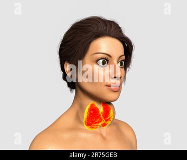 Thyreotoxische Struma (Struma), Illustration. Struma (geschwollener Hals) bei einer Patientin mit überaktiver Schilddrüse. Eine Struma wird verursacht Stockfoto