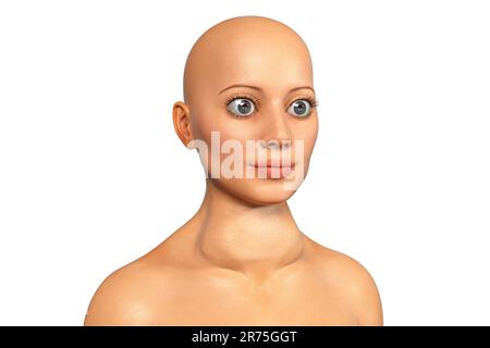 Thyreotoxische Struma (Struma), Illustration. Struma (geschwollener Hals) bei einer Patientin mit überaktiver Schilddrüse. Eine Struma wird verursacht Stockfoto