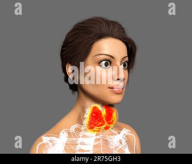 Thyreotoxische Struma (Struma), Illustration. Struma (geschwollener Hals) bei einer Patientin mit überaktiver Schilddrüse. Eine Struma wird verursacht Stockfoto