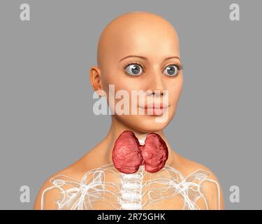 Thyreotoxische Struma (Struma), Illustration. Struma (geschwollener Hals) bei einer Patientin mit überaktiver Schilddrüse. Eine Struma wird verursacht Stockfoto