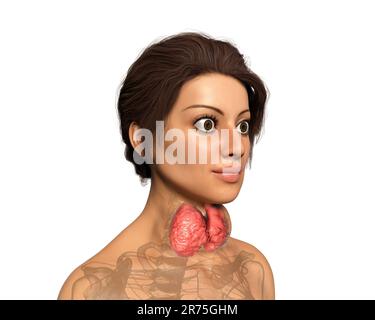 Thyreotoxische Struma (Struma), Illustration. Struma (geschwollener Hals) bei einer Patientin mit überaktiver Schilddrüse. Eine Struma wird verursacht Stockfoto