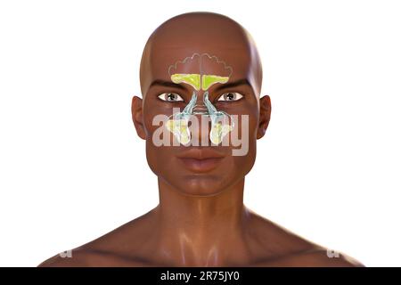 Sinusitis, Computerdarstellung. Die Nasennebenhöhlen sind membrangesäumte, luftgefüllte Räume in den Knochen des Gesichts. Die Stirnhöhlen befinden sich über den Augen. B Stockfoto