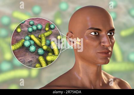 Otitis media, eine Gruppe entzündlicher Erkrankungen des Mittelohres. Computerabbildung eines Mannes mit hervorgehobenen Strukturen in der Mitte und in Stockfoto