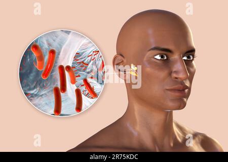 Otitis media, eine Gruppe entzündlicher Erkrankungen des Mittelohres. Computerabbildung eines Mannes mit hervorgehobenen Strukturen in der Mitte und in Stockfoto