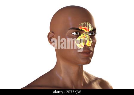 Sinusitis, Computerdarstellung. Die Nasennebenhöhlen sind membrangesäumte, luftgefüllte Räume in den Knochen des Gesichts. Die Stirnhöhlen befinden sich über den Augen. B Stockfoto
