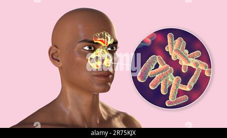 Bakterielle Sinusitis, Computerdarstellung. Die Nasennebenhöhlen sind membrangesäumte, luftgefüllte Räume in den Knochen des Gesichts. Die Stirnhöhlen liegen über t Stockfoto