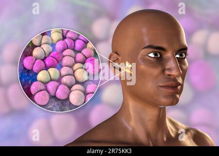 Otitis media Ohr Infektion durch Streptococcus pneumoniae Bakterien verursacht, konzeptionelle Computer-Illustration. Akute Otitis media ist die Entzündung der Th Stockfoto