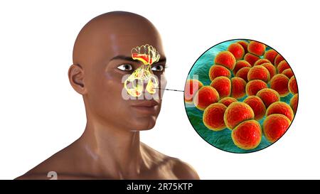 Bakterielle Sinusitis, Computerdarstellung. Die Nasennebenhöhlen sind membrangesäumte, luftgefüllte Räume in den Knochen des Gesichts. Die Stirnhöhlen liegen über t Stockfoto