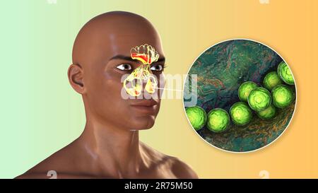 Bakterielle Sinusitis, Computerdarstellung. Die Nasennebenhöhlen sind membrangesäumte, luftgefüllte Räume in den Knochen des Gesichts. Die Stirnhöhlen liegen über t Stockfoto