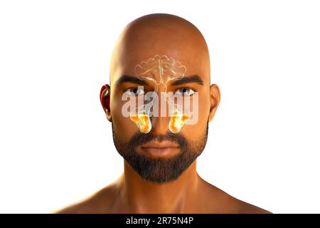 Nasennebenhöhlenentzündung oder Sinusitis, Computerdarstellung. Die Nebenhöhlen sind membranausgekleidete, luftgefüllte Räume in den Gesichtsknochen. Die Stirnhöhlen A. Stockfoto