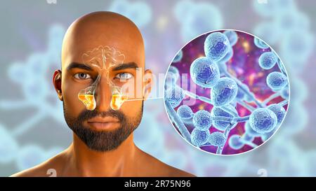 Candida-Hefepilze als Ursache einer Sinusitis. Computerdarstellung der Kieferhöhlenentzündung und Nahaufnahme von Candida-Pilzen. Stockfoto