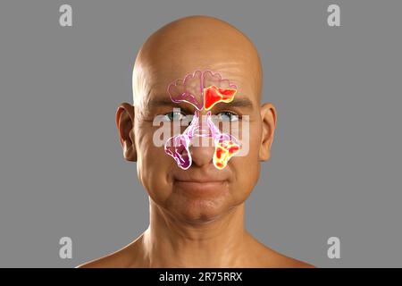 Nasennebenhöhlenentzündung oder Sinusitis, Computerdarstellung. Die Nebenhöhlen sind membranausgekleidete, luftgefüllte Räume in den Gesichtsknochen. Die Stirnhöhlen A. Stockfoto