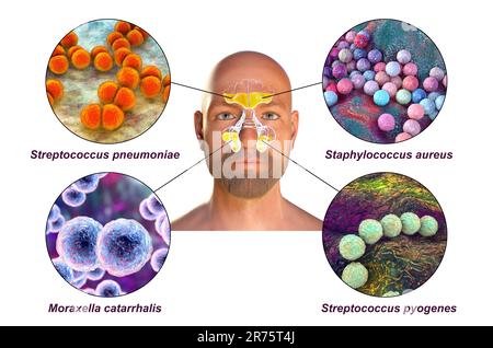 Rhinosinusitis bei einem Mann und Sinusitis-verursachende Bakterien. Streptococcus pneumoniae, Staphylococcus aureus, Moraxella catarrhalis und Streptococcus p Stockfoto
