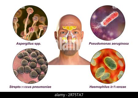 Rhinosinusitis und Mikroorganismen, die Sinusitis, Aspergillus-Pilze, Bakterien wie Pseudomonas aeruginosa, Streptococcus pneumoniae und Haemophilus verursachen Stockfoto