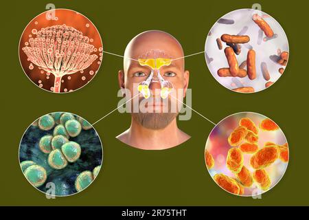 Rhinosinusitis und Mikroorganismen, die Sinusitis, Aspergillus-Pilze, Bakterien wie Pseudomonas aeruginosa, Streptococcus pneumoniae und Haemophilus verursachen Stockfoto