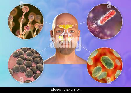 Rhinosinusitis und Mikroorganismen, die Sinusitis, Aspergillus-Pilze, Bakterien wie Pseudomonas aeruginosa, Streptococcus pneumoniae und Haemophilus verursachen Stockfoto