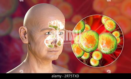 Moraxella-catarrhalis-Bakterien als Ursache einer Sinusitis. Computerdarstellung mit Entzündung der Stirn- und Kieferhöhlen und Nahaufnahme Stockfoto