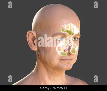 Nasennebenhöhlenentzündung oder Sinusitis, Computerdarstellung. Die Nebenhöhlen sind membranausgekleidete, luftgefüllte Räume in den Gesichtsknochen. Die Stirnhöhlen A. Stockfoto