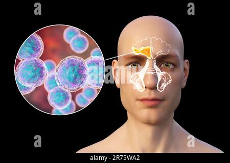 Moraxella-catarrhalis-Bakterien als Ursache einer Sinusitis. Computerdarstellung einer Entzündung der Stirnhöhlen und Nahaufnahme von Moraxella B. Stockfoto